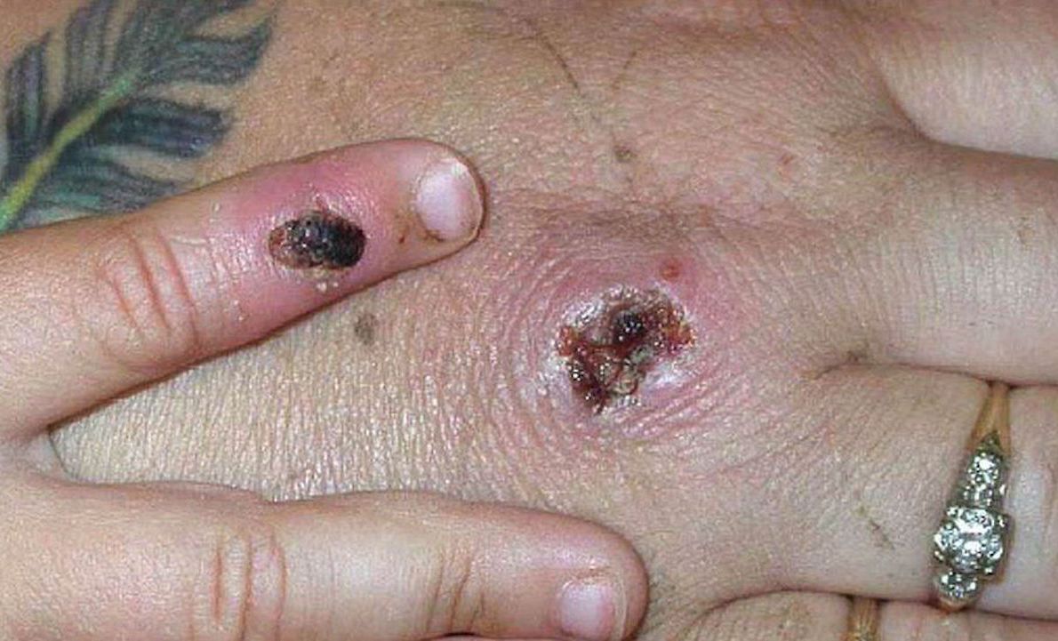 Twenty Cases of Monkeypox Identified by UK Health Security Agency. Predominantly in Gay