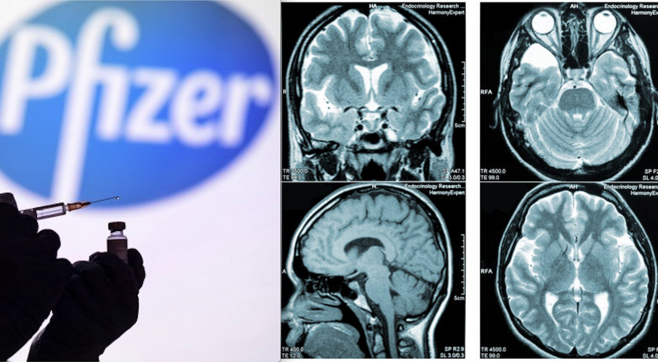 Brain Damages after COVID mRNA Vaccines: Pfizer Knew of 44,000 Injured since 2020! Study confirms Alert already launched by CDC and FDA