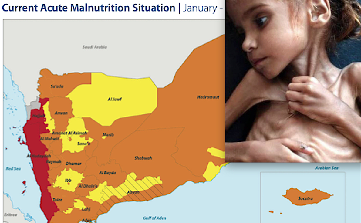 Worse than Ukraine! In Yemen “Catastrophic” Hunger due to Saudi War: 400,000 Toddlers at “Risk of Death”