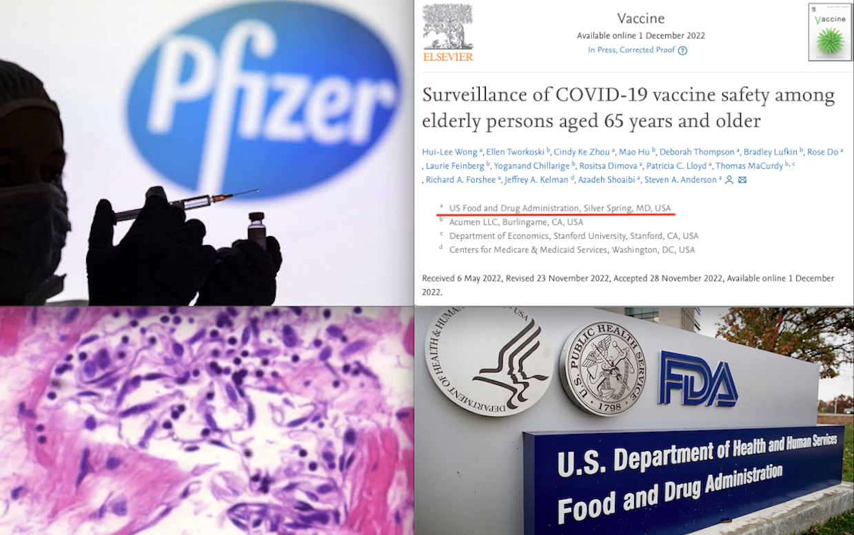 Pfizer mRNA Vaccine: Risks of Pulmonary Embolism, Myocarditis, Blood Clots, Immune Thrombosis. Finally Released the FDA Surveillance Data