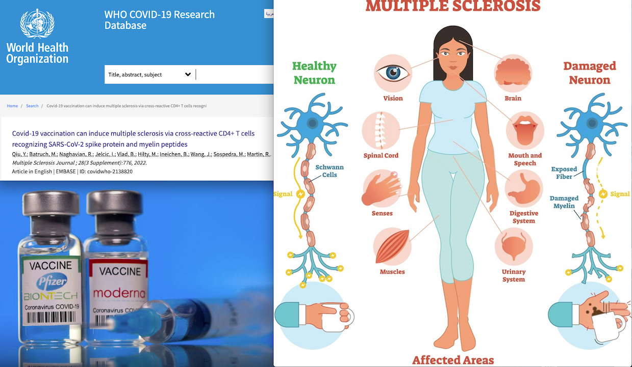 Vital! “Covid-19 mRNA Vaccination can Induce Multiple Sclerosis”. University Hospital Zurich and WHO Warning! 273 Cases in VAERS Adverse Reactions