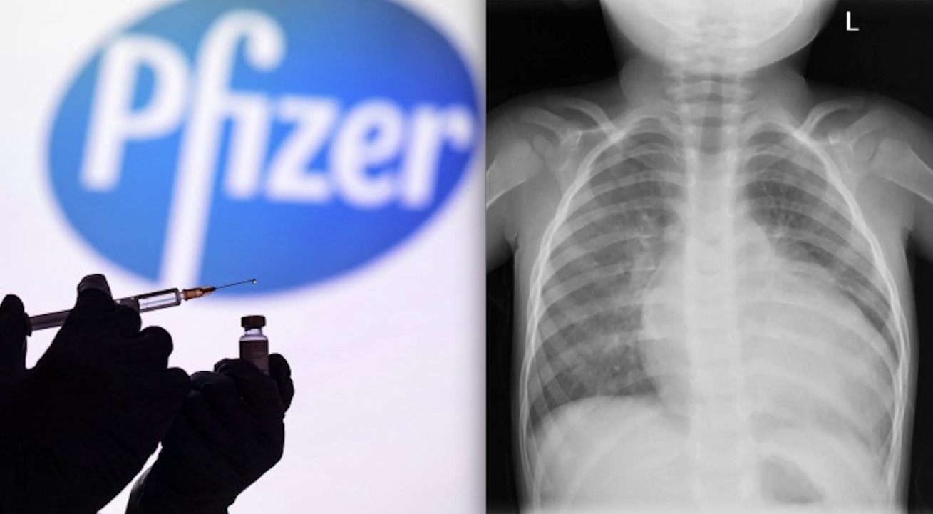 SCANDALl! Pfizer Knew very Soon that its Covid mRNA Vaccine caused Heart Damage on Kids. But has Used them as Guinea-Pig
