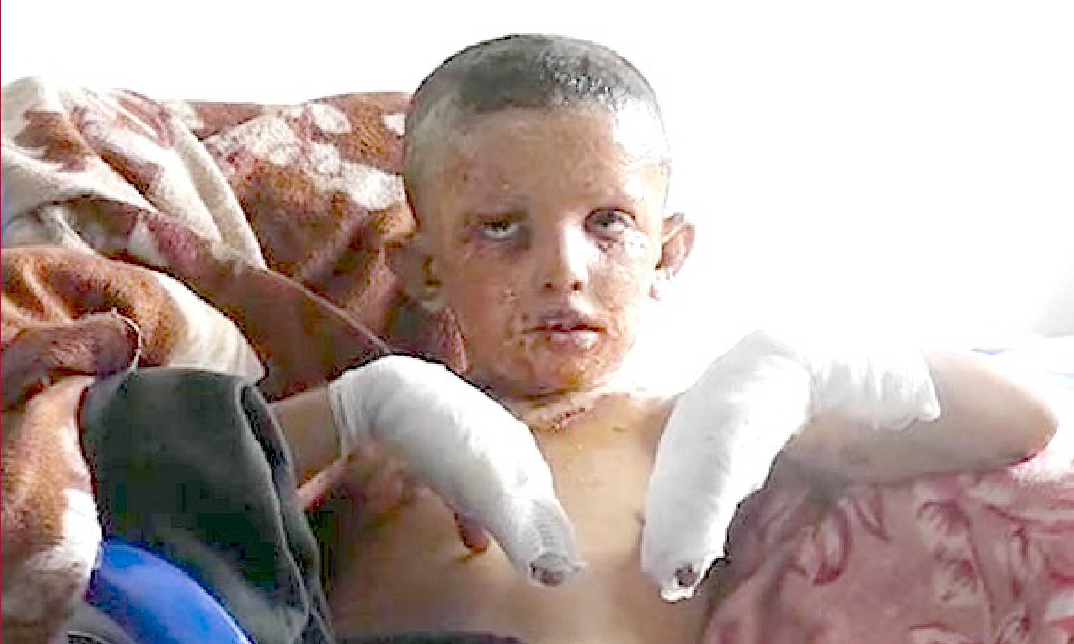 SIRIA: I CRIMINI DI GUERRA DI ERDOGAN: tregua rotta dai Turchi con 18 vittime. Fosforo bianco contro i bimbi