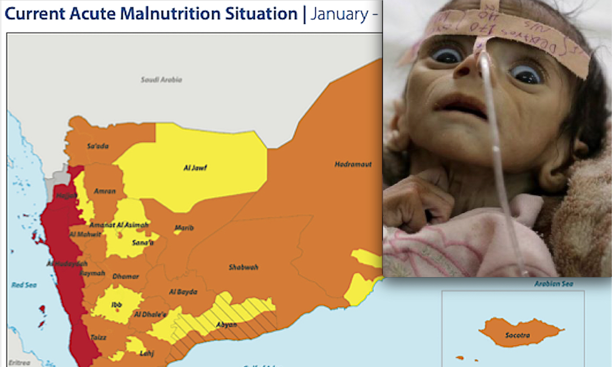 BIMBI IN GUERRA: YEMEN PEGGIO DELL’UCRAINA! 400mila Neonati a rischio di Morte Imminente per Fame. Dopo Bombe Italiane