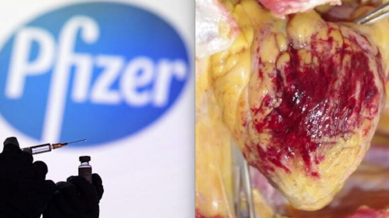 CUORE DEVASTATO DAI VACCINI COVID PFIZER. Strani e Letali Coaguli di Sangue, Pericardite e Infiammazioni Autoimmuni confermate da Autopsie Giapponesi