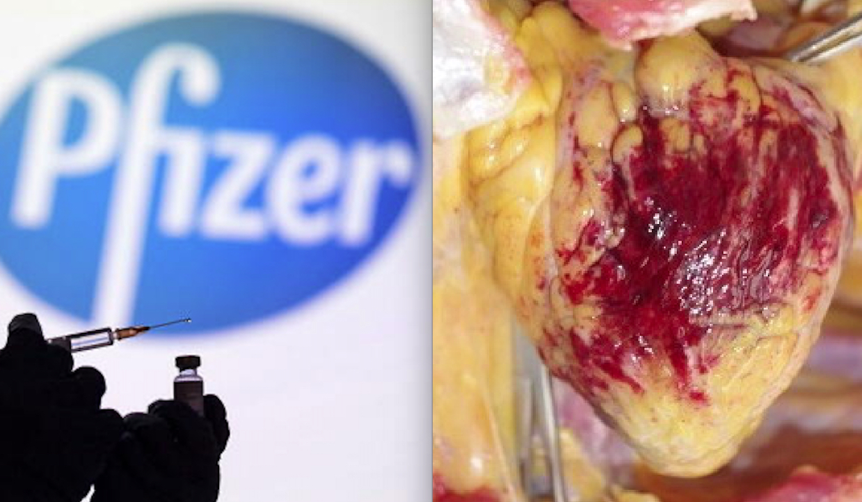 CUORE DEVASTATO DAI VACCINI COVID PFIZER. Strani e Letali Coaguli di Sangue, Pericardite e Infiammazioni Autoimmuni confermate da Autopsie Giapponesi