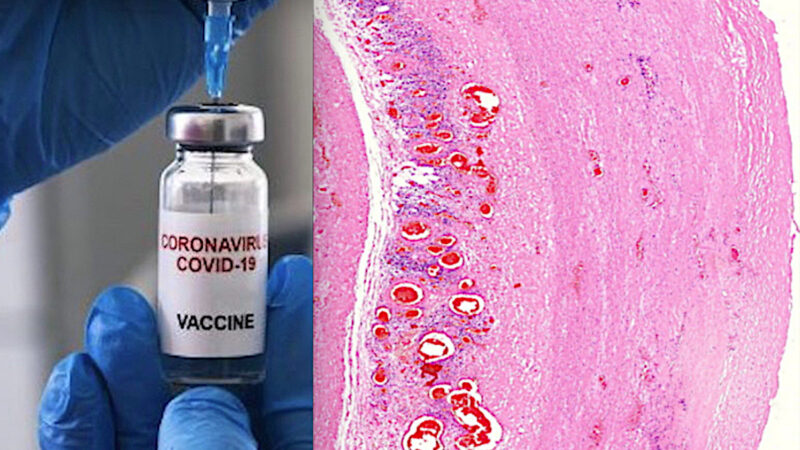 VACCINI COVID: ALTRO STUDIO TREMENDO! Gravi Danni ai Vasi Sanguigni, Modifica DNA e probabile Causa di LONG-COVID