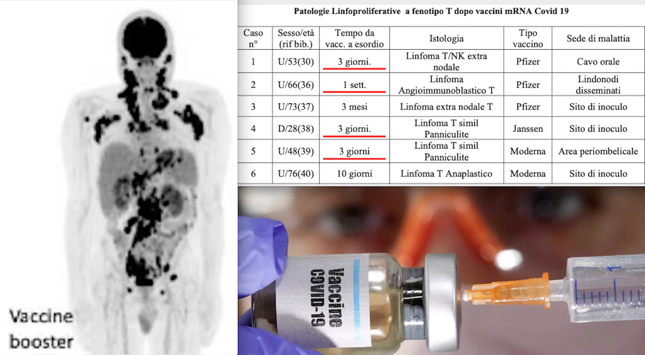 VACCINATI COVID: TURBO-CANCRO DOPO POCHI GIORNI-ORE! 26 Casi SHOCK in Studio di Oncologa Italiana sul Rischio Cancerogeno mRNA