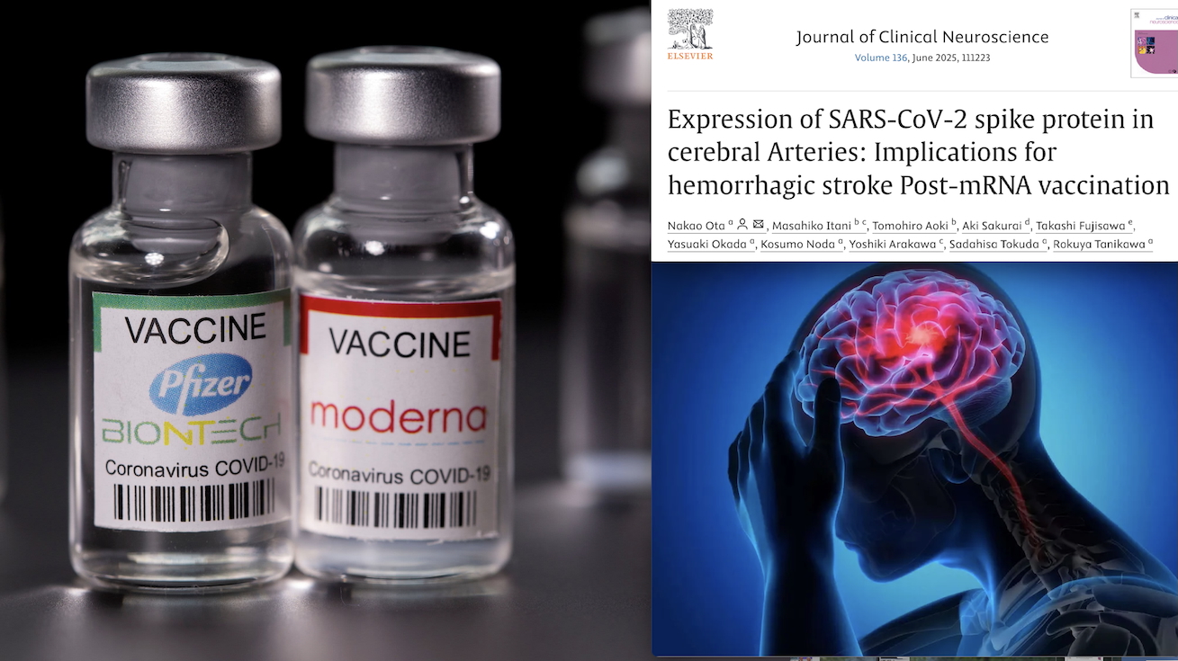 Studio Shock Giapponese: SPIKE TOSSICA DEI VACCINI COVID NELLE ARTERIE CEREBRALI DOPO ICTUS EMORRAGICI. Proteina “Killer” trovata 17 mesi dopo le Vaccinazioni